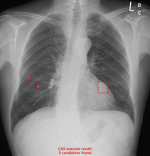 胸部X線AI読影のイメージ